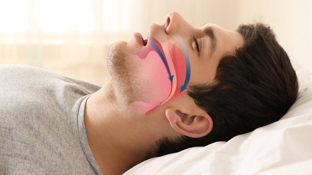 Schlafapnoe – wenn Atemaussetzer den Schlaf stören Schlafapnoe – wenn Atemaussetzer den Schlaf stören